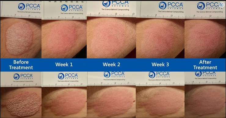 Help for Eczema, Psoriasis, & Xerosis