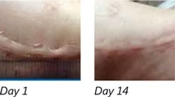 Combining Science & Nature to Combat Scars
