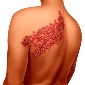 Addressing the Pain of Shingles
