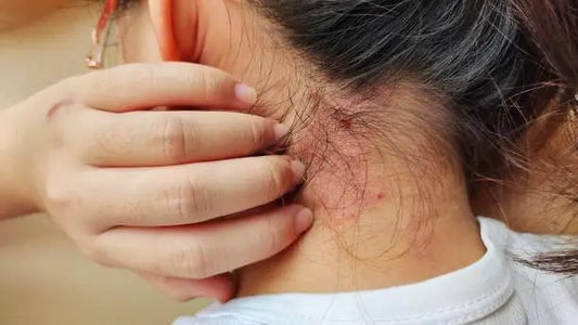 Supplements for Eczema: Natural Relief for Your Skin